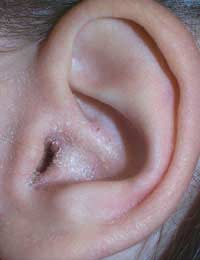 Otitis Externa Ear Infections Bacteria