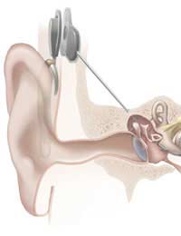 Cochlear Implant Hearing Aid Partially