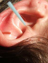 Auricular Acupuncture; Ear; Needles;