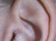 What is Otitis Externa?