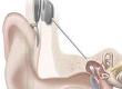 How Does a Cochlear Implant Work?