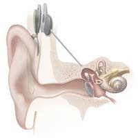 Profound Deafness Cochlear Implant