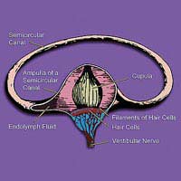 Meniere's Disease Migraine Sickness