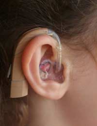 Hearing Loss; Deafness; Conductive