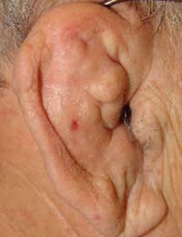 Cauliflower Ears; Contact Sports;