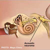 Acoustic Neuroma; Benign Tumour;